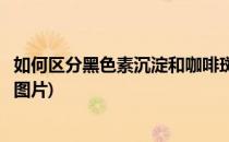 如何区分黑色素沉淀和咖啡斑(如何区分黑色素沉淀和咖啡斑图片)