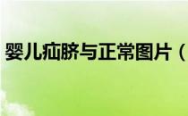 婴儿疝脐与正常图片（婴儿脐疝严重的图片）