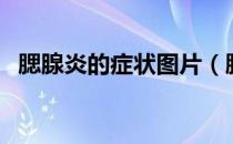 腮腺炎的症状图片（腮腺炎的症状及图片）