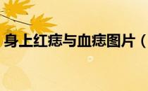 身上红痣与血痣图片（身上红痣与血痣图片）