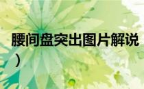 腰间盘突出图片解说（腰间盘突出图片及位置）