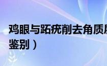 鸡眼与跖疣削去角质层后区别（鸡眼与跖疣的鉴别）