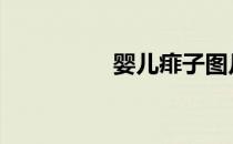 婴儿痱子图片 痱子图片