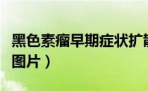 黑色素瘤早期症状扩散吗（黑色素瘤早期症状图片）