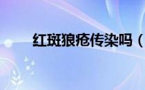 红斑狼疮传染吗（红斑狼疮传染吗）