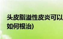 头皮脂溢性皮炎可以根治吗(头皮溢脂性皮炎如何根治)