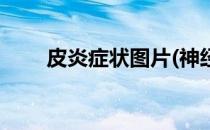 皮炎症状图片(神经性皮炎症状图片)