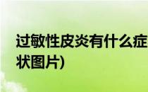 过敏性皮炎有什么症状(过敏性皮炎有什么症状图片)