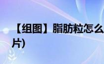 【组图】脂肪粒怎么去除(肪脂粒怎么祛掉图片)