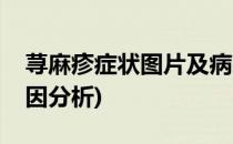 荨麻疹症状图片及病因(荨麻疹症状图片及病因分析)