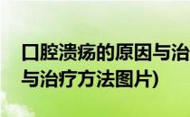 口腔溃疡的原因与治疗方法(口腔溃疡的原因与治疗方法图片)