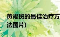 黄褐斑的最佳治疗方法(黄褐斑的最佳治疗方法图片)