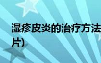 湿疹皮炎的治疗方法(湿疹皮炎的治疗方法图片)