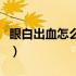 眼白出血怎么治疗最有效（眼白出血怎么回事）