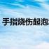 手指烧伤起泡怎么处理（烧伤起泡怎么处理）
